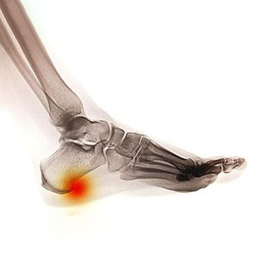 Heel Spurs Treatment in the Florence County, SC: Florence (Quinby, Effingham, Peniel Crossroads, Sardis, Timmonsville, Winona, Coward) and Darlington County, SC: Darlington, Lamar, Floyd areas