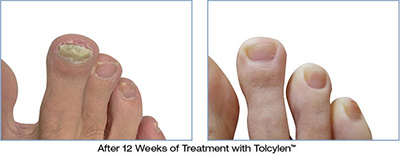 Tolcylen Podiatric Products and treatment in the Florence County, SC: Florence (Quinby, Effingham, Peniel Crossroads, Sardis, Timmonsville, Winona, Coward) and Darlington County, SC: Darlington, Lamar, Floyd areas
