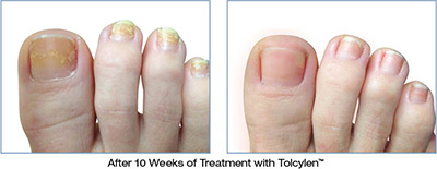 Tolcylen Treatment in the Florence County, SC: Florence (Quinby, Effingham, Peniel Crossroads, Sardis, Timmonsville, Winona, Coward) and Darlington County, SC: Darlington, Lamar, Floyd areas